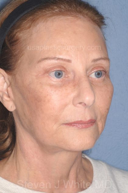 Upper & Lower Facelift - Brow Lift & Face/Neck Lift Before & After Patient #8032