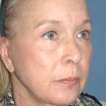 Upper & Lower Facelift - Brow Lift & Face/Neck Lift Before & After Patient #8034
