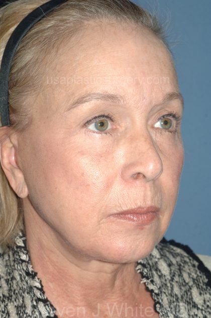 Upper & Lower Facelift - Brow Lift & Face/Neck Lift Before & After Patient #8034