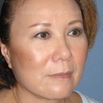 Upper & Lower Facelift - Brow Lift & Face/Neck Lift Before & After Patient #8033