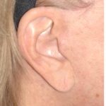 Facelift - Scar Before & After Patient #8171
