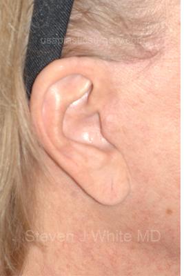 Facelift - Scar Before & After Patient #8171