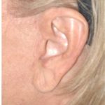 Facelift - Scar Before & After Patient #8171