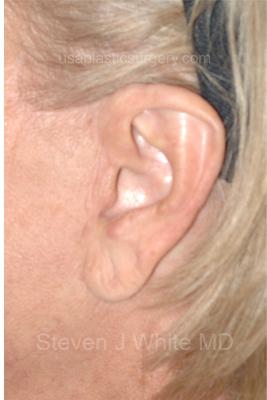 Facelift - Scar Before & After Patient #8171