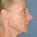 Upper & Lower Facelift - Brow Lift & Face/Neck Lift Before & After Patient #8027