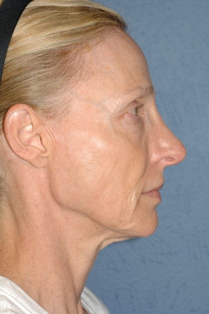 Upper & Lower Facelift - Brow Lift & Face/Neck Lift Before & After Patient #8027