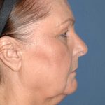 Upper & Lower Facelift - Brow Lift & Face/Neck Lift Before & After Patient #8301