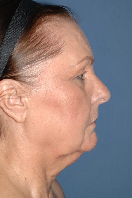 Upper & Lower Facelift - Brow Lift & Face/Neck Lift Before & After Patient #8301