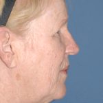 Upper & Lower Facelift - Brow Lift & Face/Neck Lift Before & After Patient #8303
