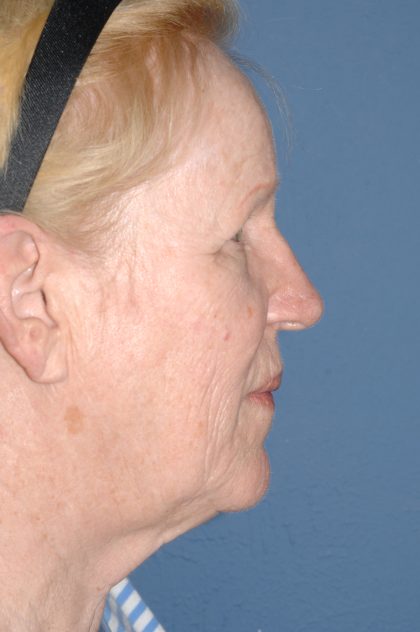 Upper & Lower Facelift - Brow Lift & Face/Neck Lift Before & After Patient #8303