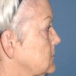 Upper & Lower Facelift - Brow Lift & Face/Neck Lift Before & After Patient #8302
