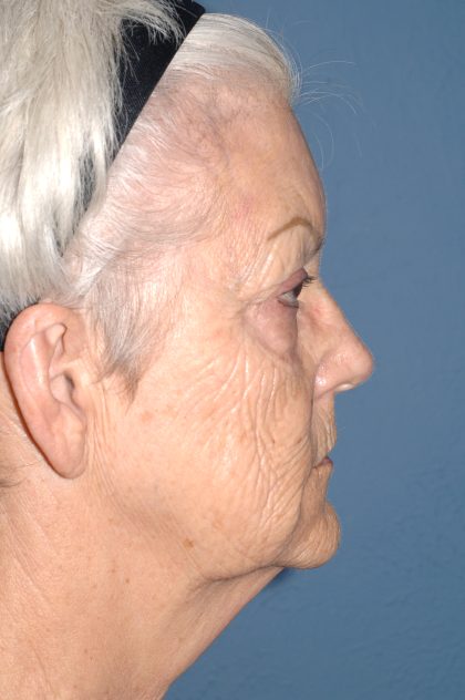 Upper & Lower Facelift - Brow Lift & Face/Neck Lift Before & After Patient #8302