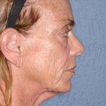 Upper & Lower Facelift - Brow Lift & Face/Neck Lift Before & After Patient #8304