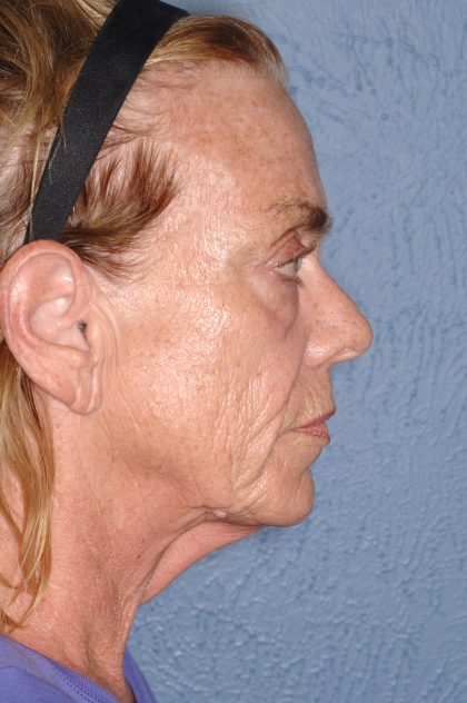 Upper & Lower Facelift - Brow Lift & Face/Neck Lift Before & After Patient #8304
