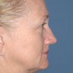 Upper & Lower Facelift - Brow Lift & Face/Neck Lift Before & After Patient #8305