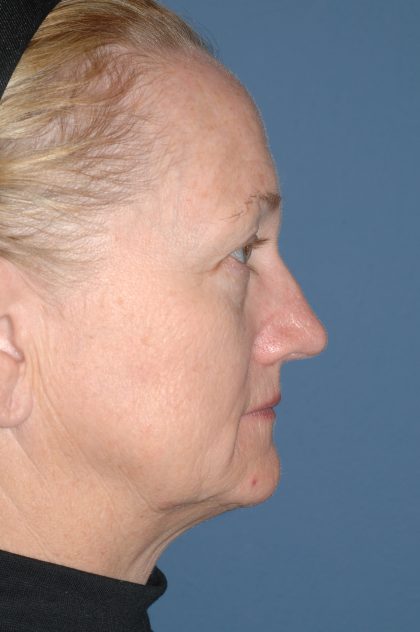 Upper & Lower Facelift - Brow Lift & Face/Neck Lift Before & After Patient #8305