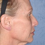 Upper & Lower Facelift - Brow Lift & Face/Neck Lift Before & After Patient #8026