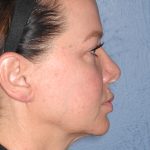 Upper & Lower Facelift - Brow Lift & Face/Neck Lift Before & After Patient #8028