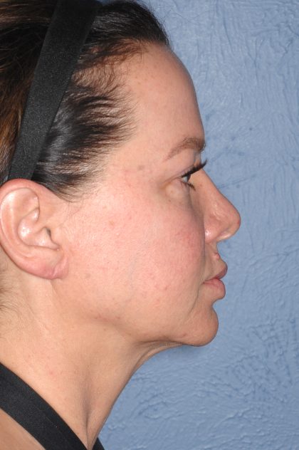 Upper & Lower Facelift - Brow Lift & Face/Neck Lift Before & After Patient #8028