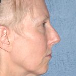 Upper & Lower Facelift - Brow Lift & Face/Neck Lift Before & After Patient #8029