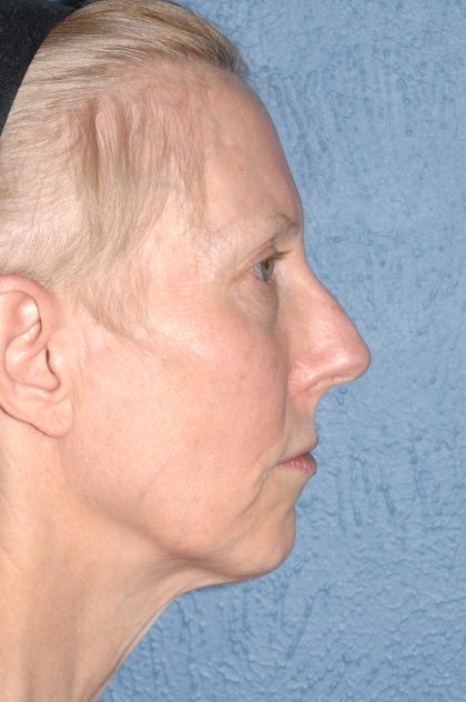 Upper & Lower Facelift - Brow Lift & Face/Neck Lift Before & After Patient #8029