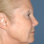 Upper & Lower Facelift - Brow Lift & Face/Neck Lift Before & After Patient #8030