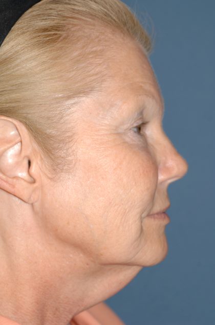 Upper & Lower Facelift - Brow Lift & Face/Neck Lift Before & After Patient #8030