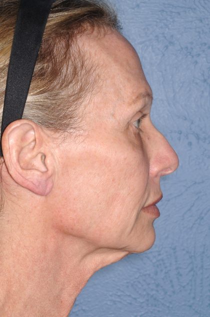 Upper & Lower Facelift - Brow Lift & Face/Neck Lift Before & After Patient #8026