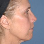 Upper & Lower Facelift - Brow Lift & Face/Neck Lift Before & After Patient #8031