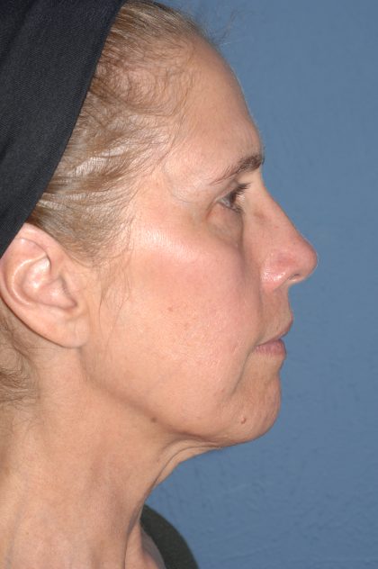 Upper & Lower Facelift - Brow Lift & Face/Neck Lift Before & After Patient #8031