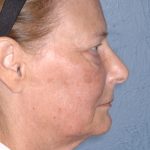 Upper & Lower Facelift - Brow Lift & Face/Neck Lift Before & After Patient #8032