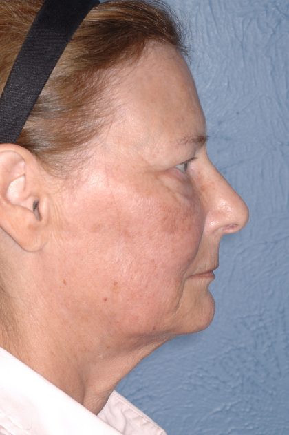 Upper & Lower Facelift - Brow Lift & Face/Neck Lift Before & After Patient #8032