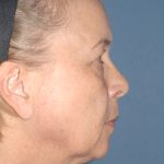 Upper & Lower Facelift - Brow Lift & Face/Neck Lift Before & After Patient #8034