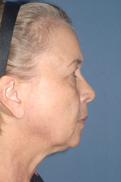 Upper & Lower Facelift - Brow Lift & Face/Neck Lift Before & After Patient #8034
