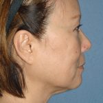 Upper & Lower Facelift - Brow Lift & Face/Neck Lift Before & After Patient #8033