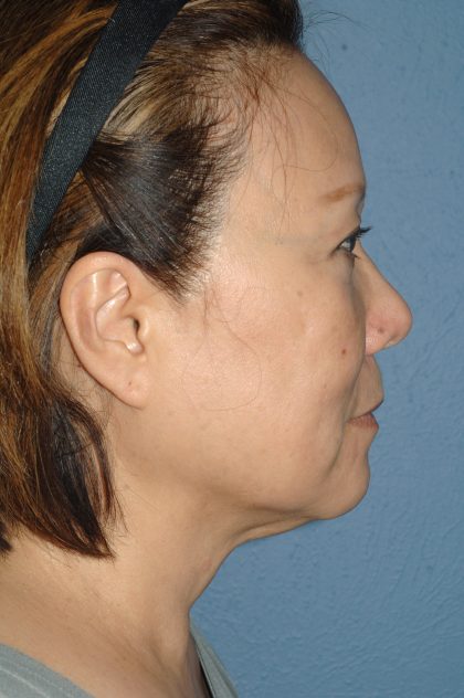 Upper & Lower Facelift - Brow Lift & Face/Neck Lift Before & After Patient #8033