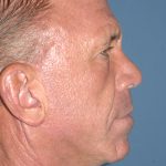Upper & Lower Facelift - Brow Lift & Face/Neck Lift Before & After Patient #8035