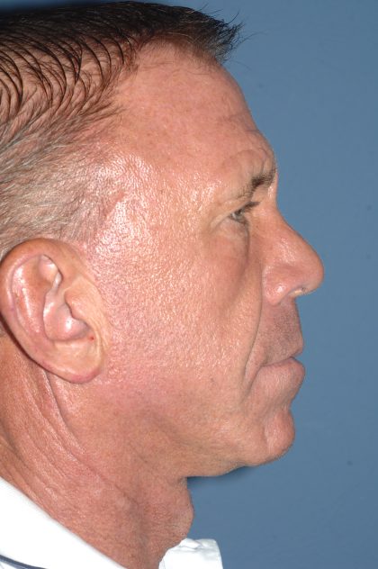 Upper & Lower Facelift - Brow Lift & Face/Neck Lift Before & After Patient #8035
