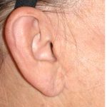 Facelift - Scar Before & After Patient #8172