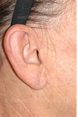 Facelift - Scar Before & After Patient #8172