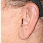 Facelift - Scar Before & After Patient #8172