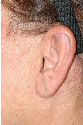 Facelift - Scar Before & After Patient #8172