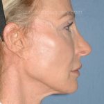Upper & Lower Facelift - Brow Lift & Face/Neck Lift Before & After Patient #8027