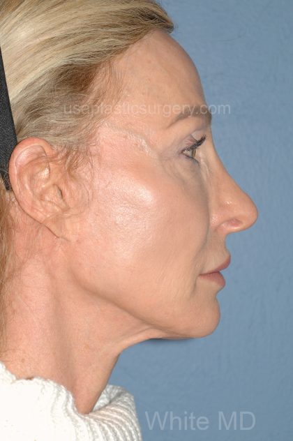 Upper & Lower Facelift - Brow Lift & Face/Neck Lift Before & After Patient #8027