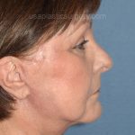 Upper & Lower Facelift - Brow Lift & Face/Neck Lift Before & After Patient #8301