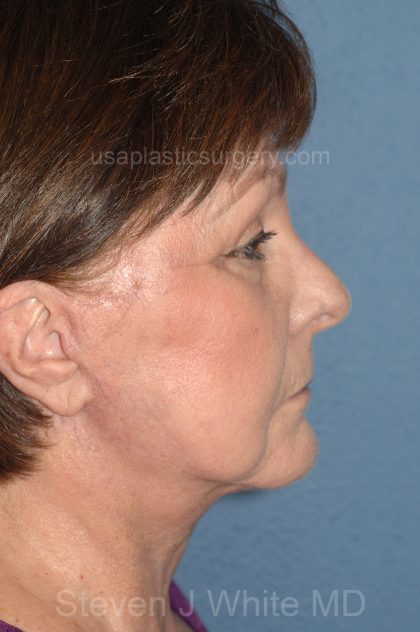 Upper & Lower Facelift - Brow Lift & Face/Neck Lift Before & After Patient #8301