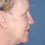Upper & Lower Facelift - Brow Lift & Face/Neck Lift Before & After Patient #8303