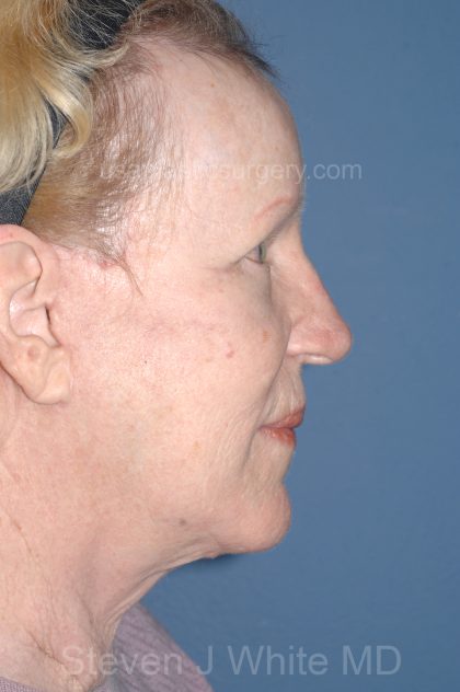 Upper & Lower Facelift - Brow Lift & Face/Neck Lift Before & After Patient #8303