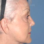 Upper & Lower Facelift - Brow Lift & Face/Neck Lift Before & After Patient #8302