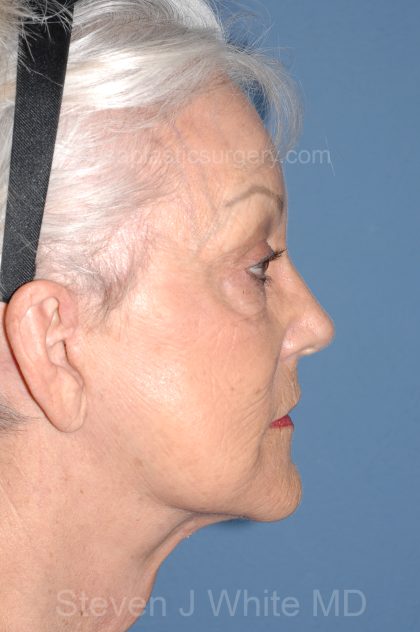 Upper & Lower Facelift - Brow Lift & Face/Neck Lift Before & After Patient #8302